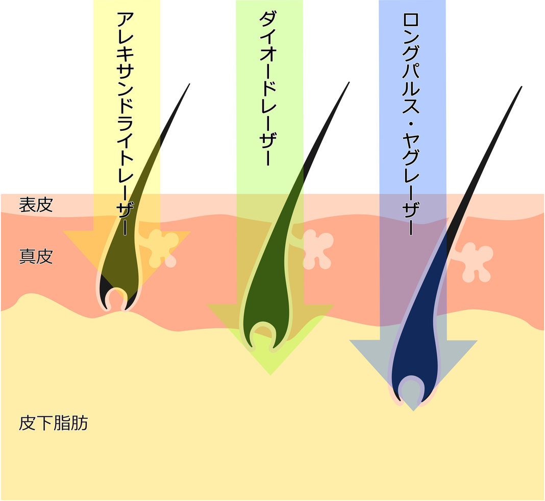 脱毛のアレキサンドライトレーザーとは？仕組みや搭載機器について解説　- 医療脱毛ならカノアクリニック